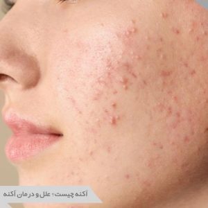 علل و درمان آکنه