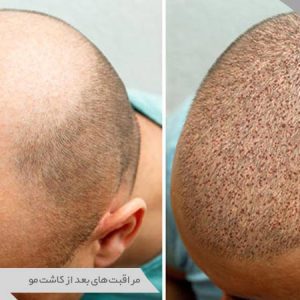 کاشت مو قبل و بعد